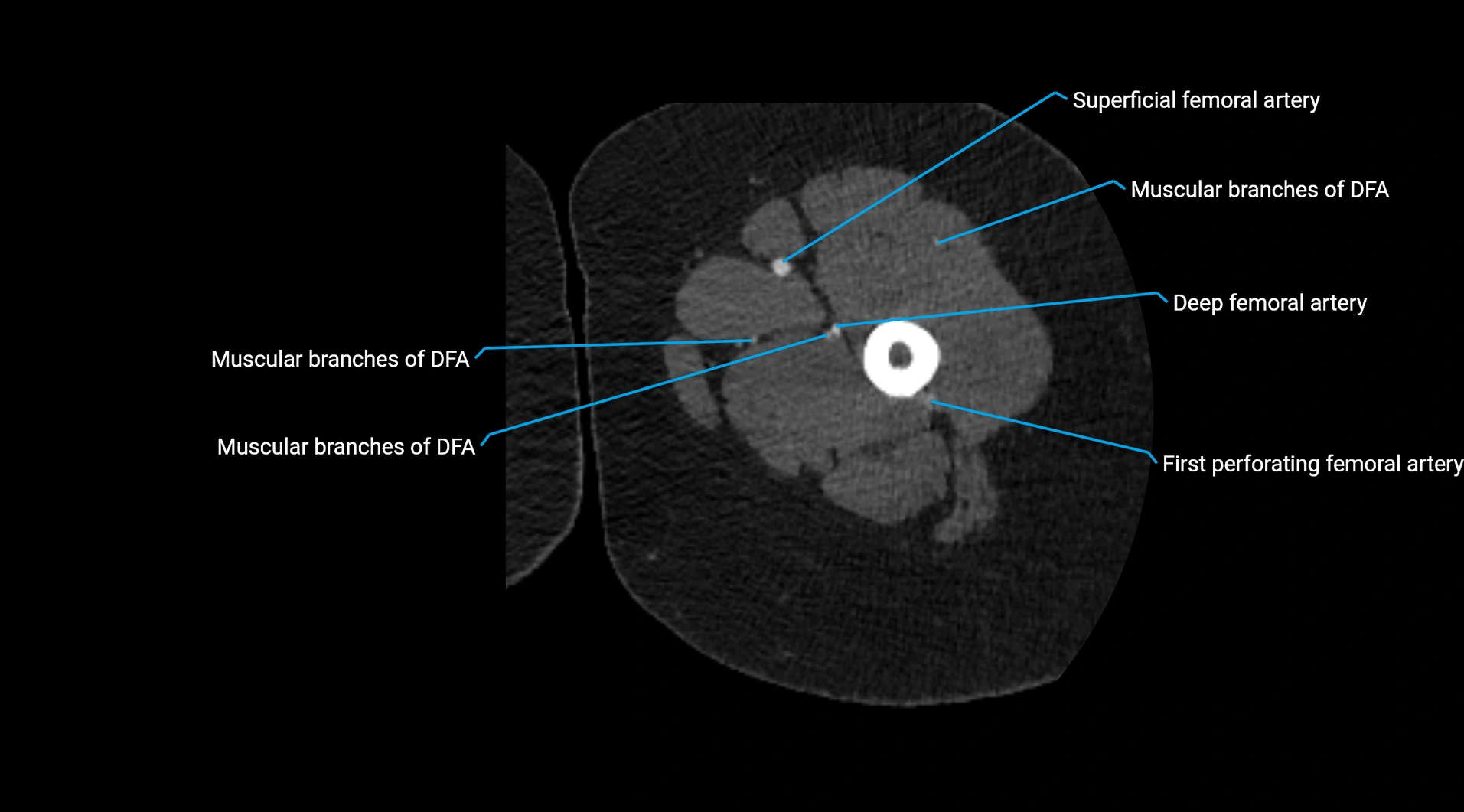 CTA lower limb cross sectional anatomy labelled image _102.webp